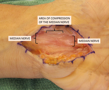 median nerve compression in carpal tunnel syndrome